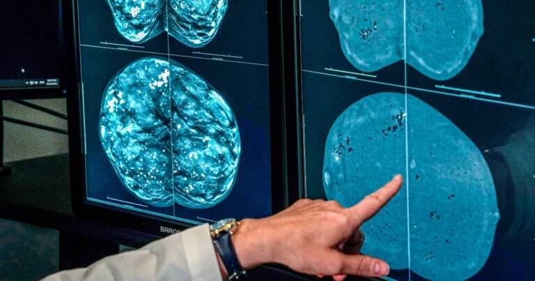 Guidance on Timing for Mammograms Amidst Conflicting Recommendations