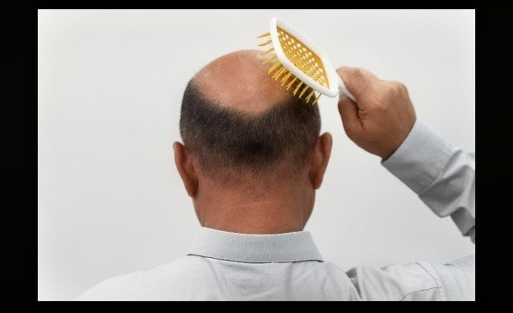 Understanding Your Family History: Approaches to Treating Hereditary Alopecia