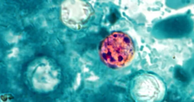Cyclospora: Symptoms, Case Statistics, Geographic Distribution, and Latest Updates as Outbreak Spreads to 31 States