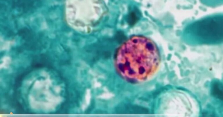 Nationwide Parasite Outbreak: Safety Measures to Protect Yourself